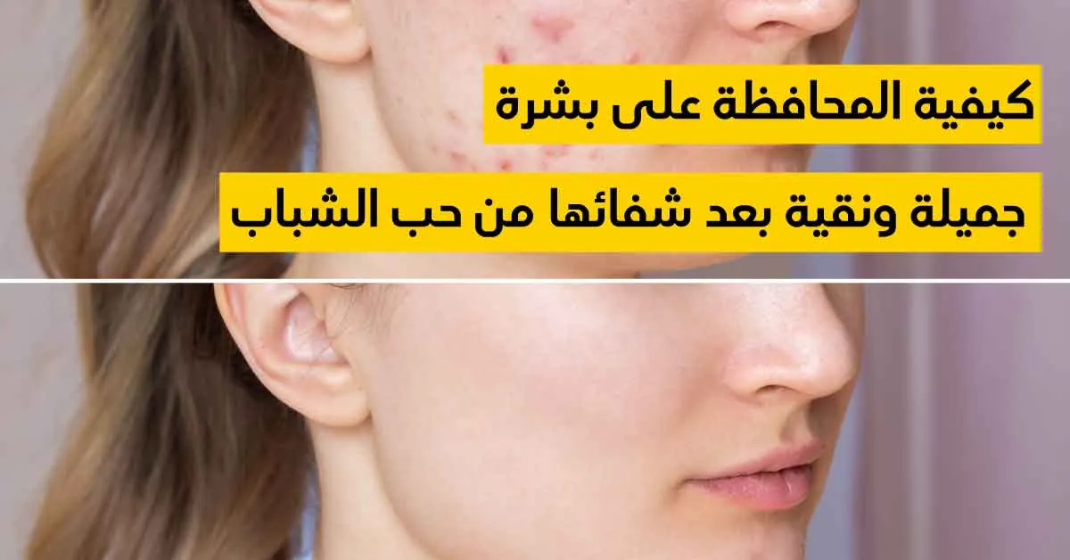 كيفية المحافظة على بشرة جميلة ونقية بعد شفائها من حب الشباب